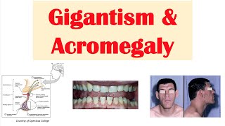 Gigantism amp Acromegaly  Growth Hormone Signs amp Symptoms Diagnosis Treatment [upl. by Nyrrek]