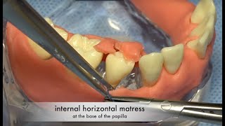 Periodontal Regenerative Emdogain Surgery with Papilla preservation  Flap design and suturing [upl. by Barny]