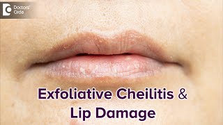 Exfoliative Cheilitis amp its effect on Lips  DRY LIPSBest TreatmentDrRasya Dixit Doctors Circle [upl. by Nnasor268]