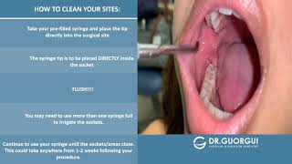 PostOperative Video Irrigation for Extraction and Wisdom Teeth [upl. by Dumah172]