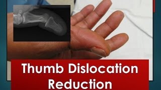 Traumatic Knee Dislocation Reduction [upl. by Delisle807]