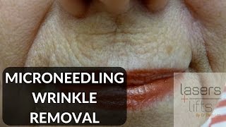 Microneedling for skin rejuvenation [upl. by Sakram906]