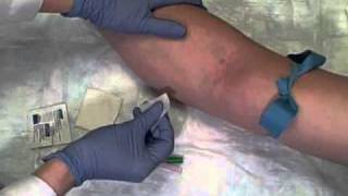 emergency Phlebotomy with 21G Butterfly Needle  drtusarofficial [upl. by Tlevesor]