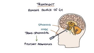 Understanding Acromegaly [upl. by Dalli]