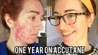 ACCUTANE Before And After Severe Acne With Pictures My Experience  Jess Bunty [upl. by O'Driscoll]