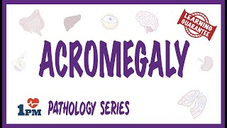 Acromegaly  Pathophysiology Symptoms Diagnosis Treatment [upl. by Rabkin933]