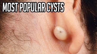 Top 5 Most Popular Pops amp Cysts [upl. by Nahtnanhoj]