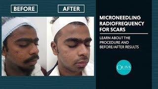 Microneedling RadiofrequencyRF Treatment Before And After Results  Oliva Clinic [upl. by Ahselaf886]