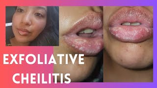 Exfoliative Cheilitis  Peeling Lips [upl. by Ellary]